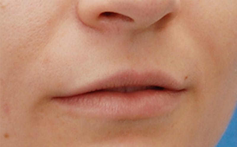 Patient RxTtME-aTq-C0Lu5wL8sbg - Lip Fillers Before & After Photos