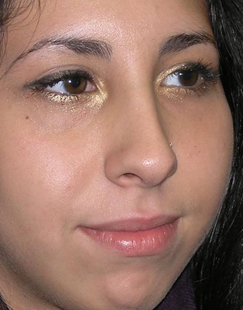 Rhinoplasty Before & After Gallery - Patient 386748 - Image 4