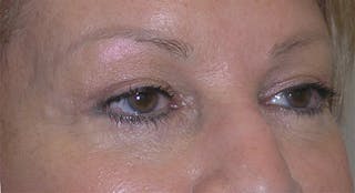 Eyelid Surgery Before & After Gallery - Patient 317197 - Image 6