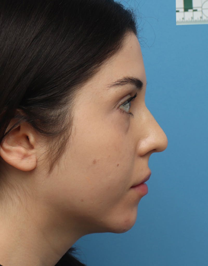 FaceTite Before & After Gallery - Patient 312157 - Image 3