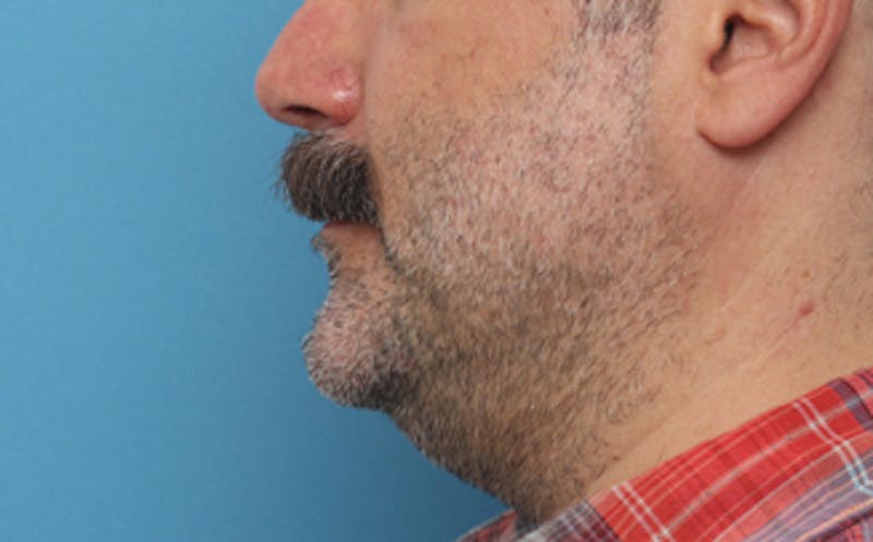 Chin Surgery Before & After Gallery - Patient 222342 - Image 5