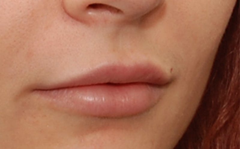 Fillers Before & After Gallery - Patient 143726 - Image 2