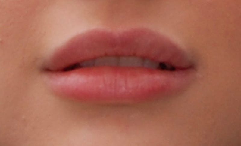 Lip Fillers Before & After Gallery - Patient 388477 - Image 8