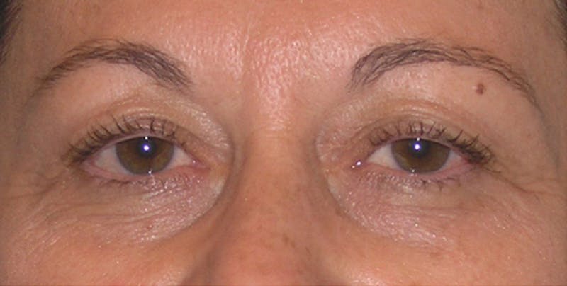 Eyelid Surgery Before & After Gallery - Patient 117182 - Image 1