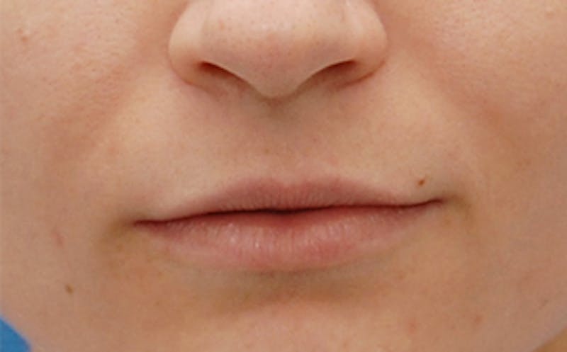 Fillers Before & After Gallery - Patient 143726 - Image 3