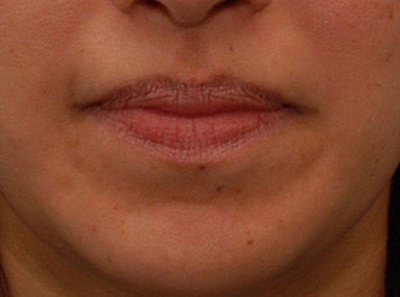 Lip Enhancement Before & After Gallery - Patient 123678 - Image 1