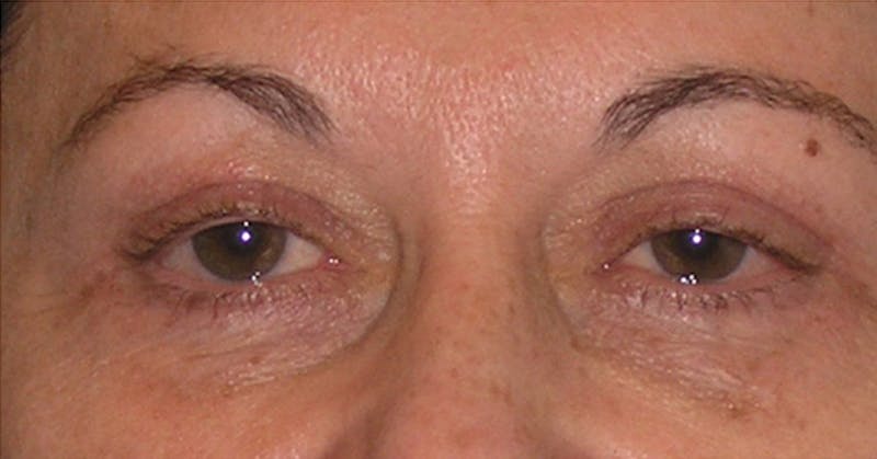 Eyelid Surgery Before & After Gallery - Patient 117182 - Image 2
