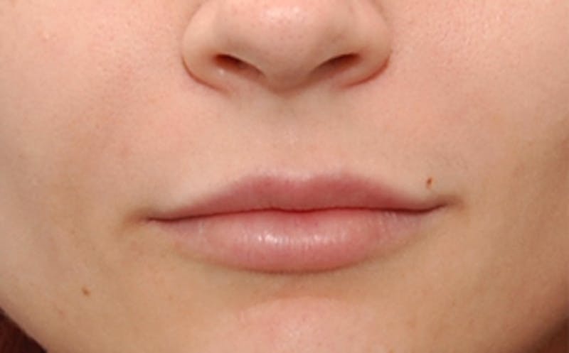 Fillers Before & After Gallery - Patient 143726 - Image 4