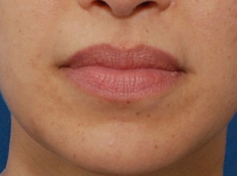 Lip Fillers Before & After Gallery - Patient 123678 - Image 2
