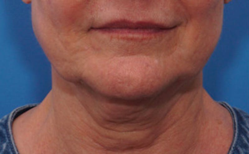 FaceTite Before & After Gallery - Patient 123057 - Image 1
