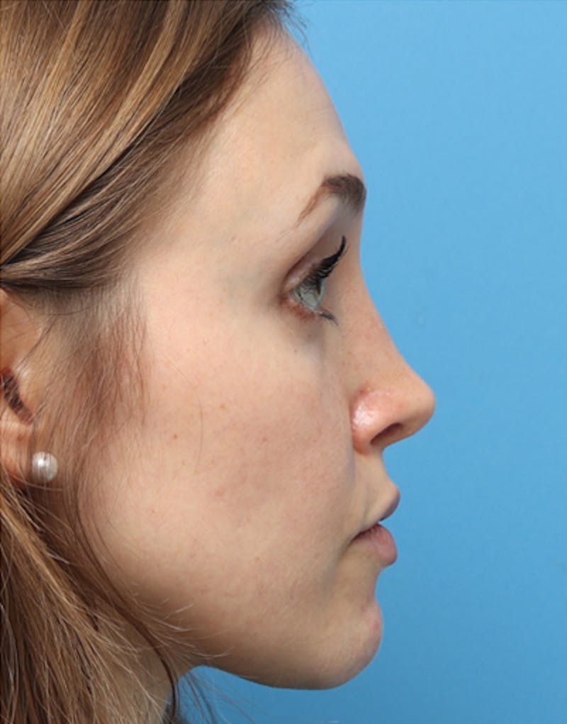 Rhinoplasty Before & After Gallery - Patient 315364 - Image 2