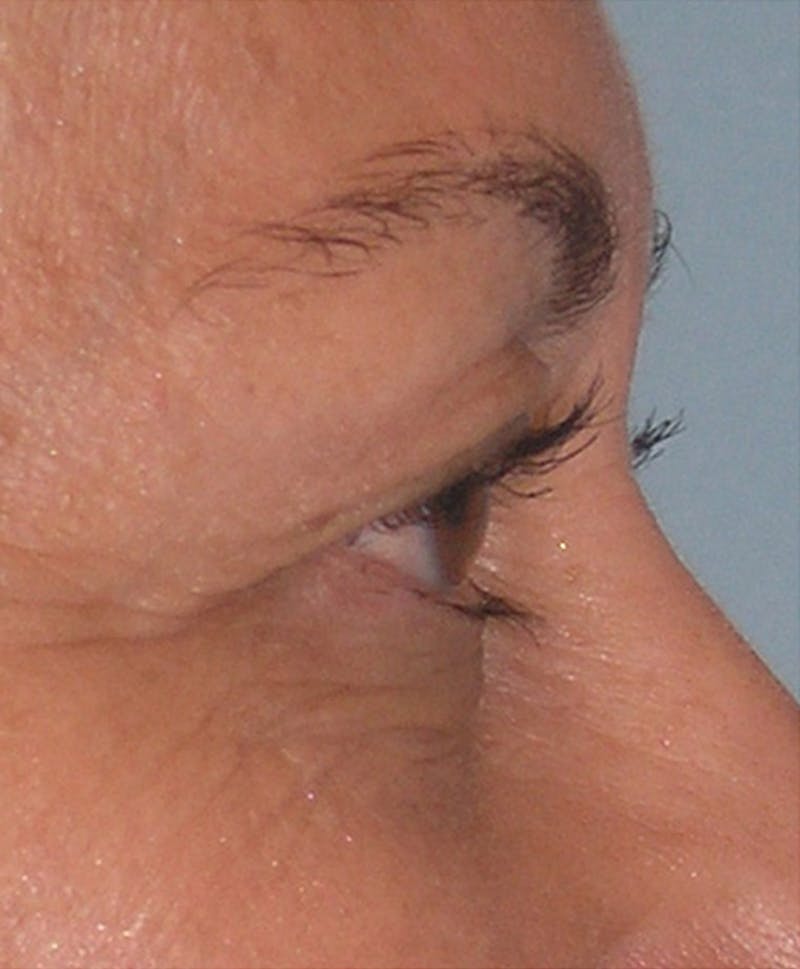 Eyelid Surgery Before & After Gallery - Patient 117182 - Image 3