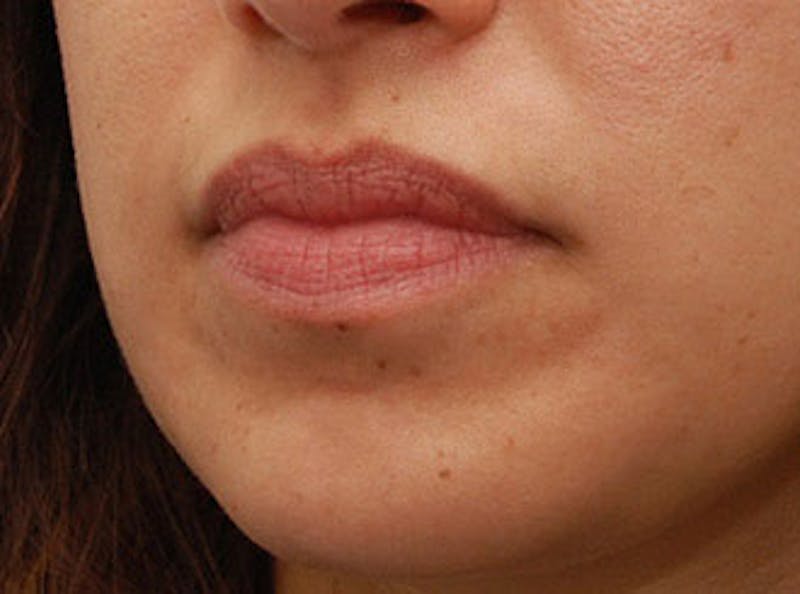 Lip Fillers Before & After Gallery - Patient 123678 - Image 3