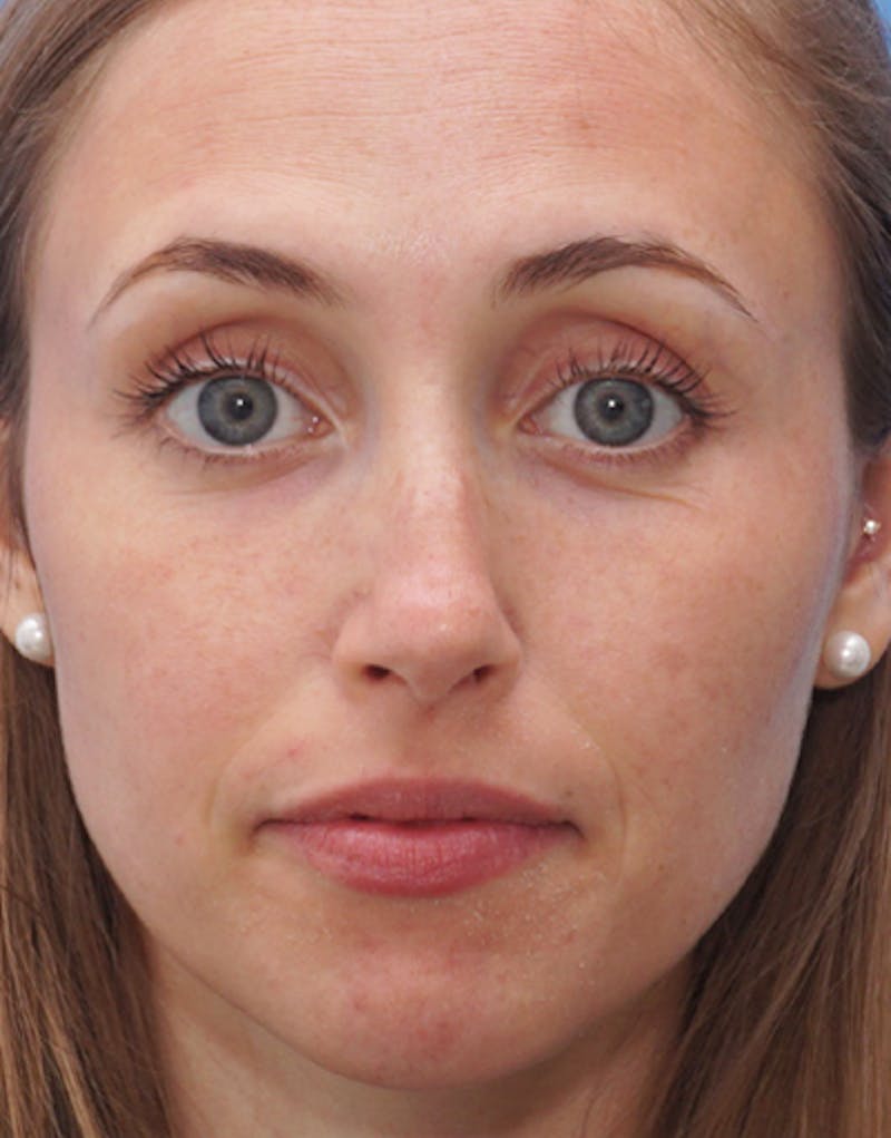Rhinoplasty Before & After Gallery - Patient 315364 - Image 3