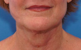 FaceTite Before & After Gallery - Patient 123057 - Image 4
