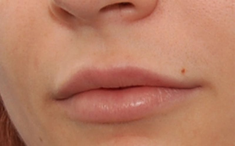 Fillers Before & After Gallery - Patient 143726 - Image 6