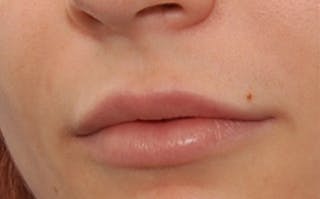 Fillers Before & After Gallery - Patient 143726 - Image 6