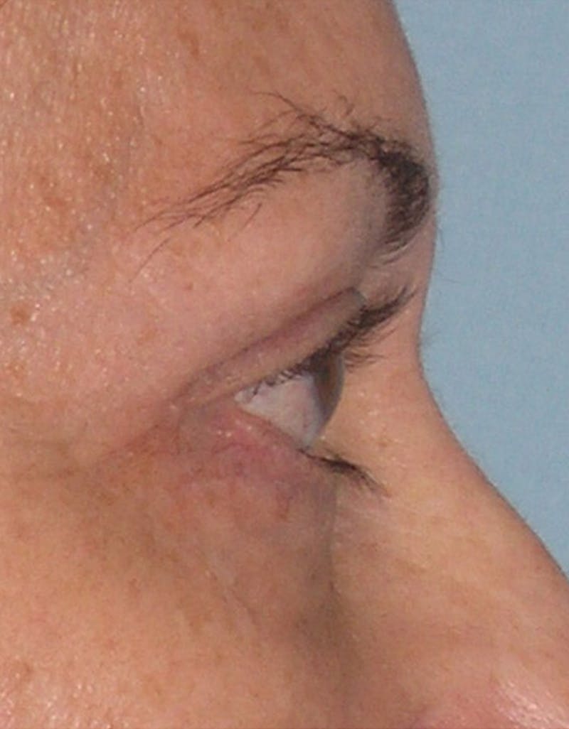 Eyelid Surgery Before & After Gallery - Patient 117182 - Image 4