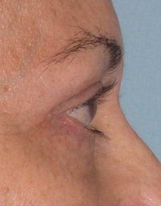 Eyelid Surgery Before & After Gallery - Patient 117182 - Image 4