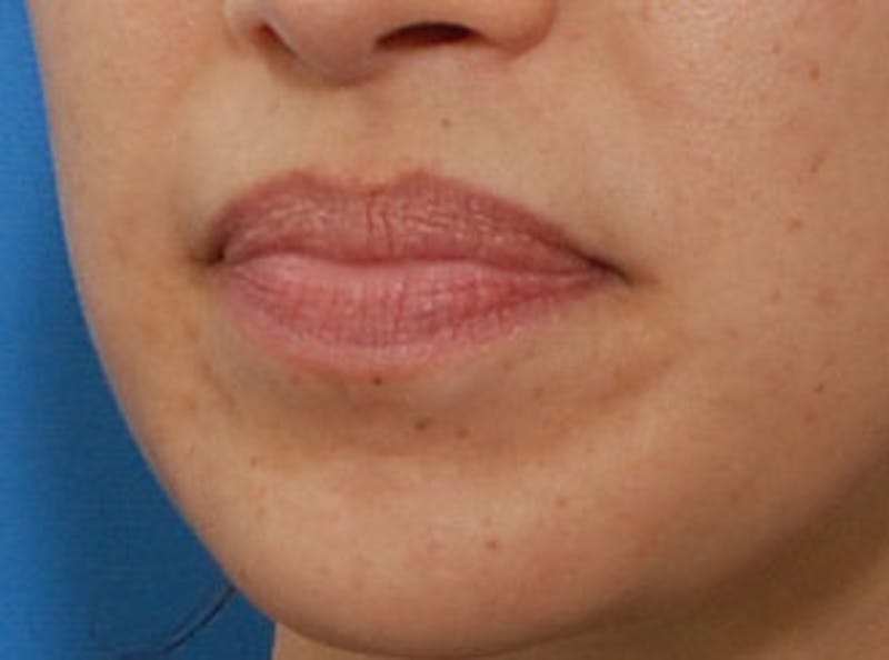 Lip Fillers Before & After Gallery - Patient 123678 - Image 4