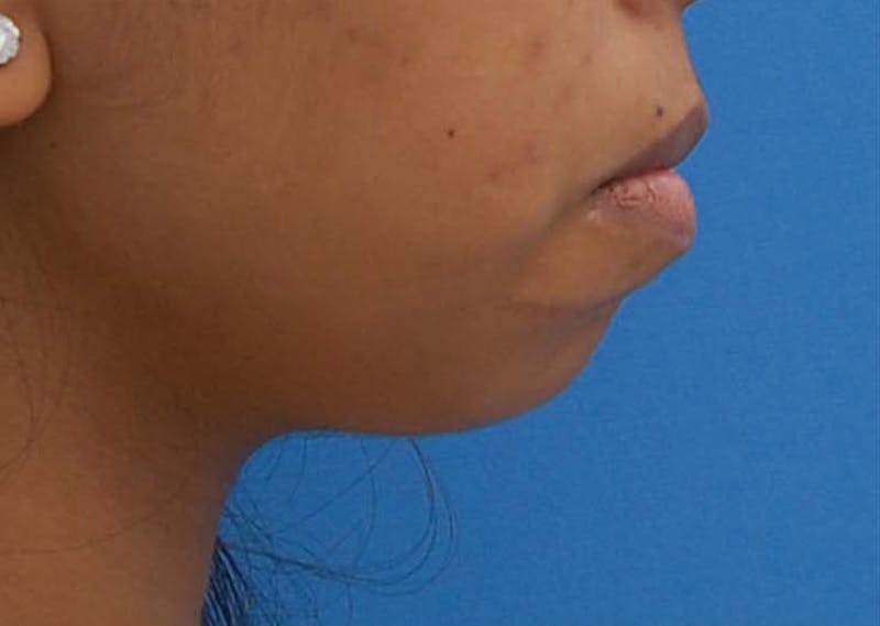 Chin Surgery Before & After Gallery - Patient 446897 - Image 1