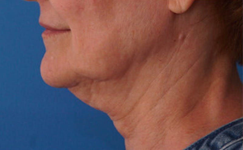 FaceTite Before & After Gallery - Patient 123057 - Image 3