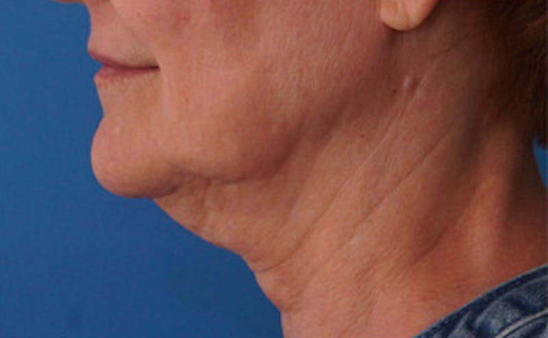 Patient H-ZbPWe9QiSrhETwwP6VzA - FaceTite Before & After Photos