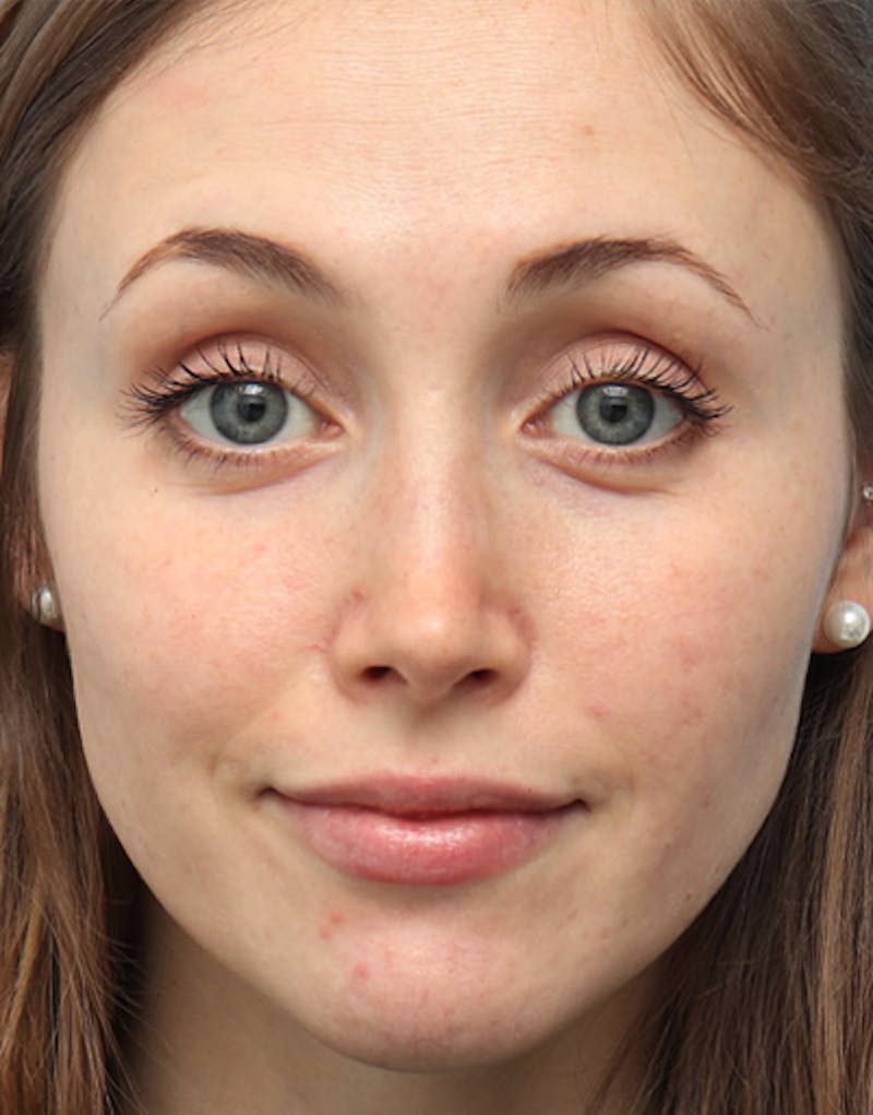 Rhinoplasty  Before & After Gallery - Patient 159484 - Image 4