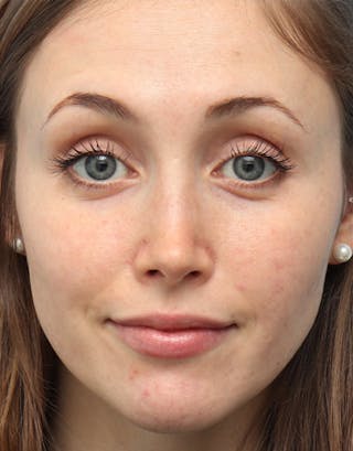 Favorite Rhinoplasty Before & After Gallery - Patient 280068 - Image 4