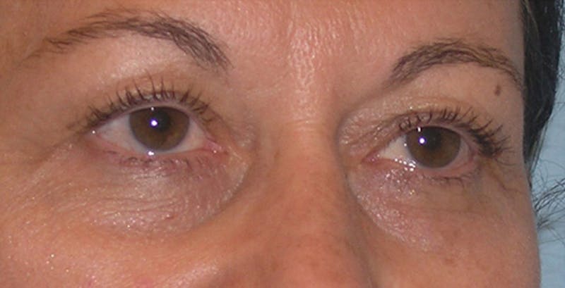 Eyelid Surgery Before & After Gallery - Patient 117182 - Image 5