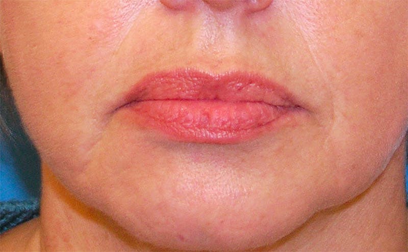 Fillers Before & After Gallery - Patient 370732 - Image 1