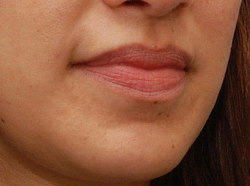 Lip Fillers Before & After Gallery - Patient 123678 - Image 5