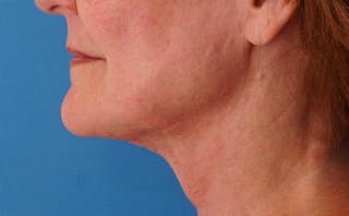 FaceTite Before & After Gallery - Patient 123057 - Image 2