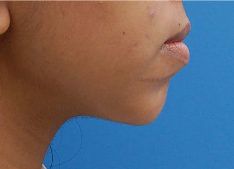 Chin Surgery Before & After Gallery - Patient 446897 - Image 2