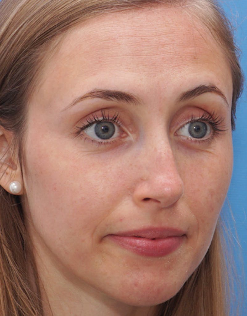 Rhinoplasty Before & After Gallery - Patient 315364 - Image 5