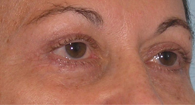 Eyelid Surgery Before & After Gallery - Patient 117182 - Image 6