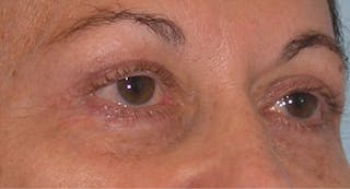 Eyelid Surgery Before & After Gallery - Patient 117182 - Image 6
