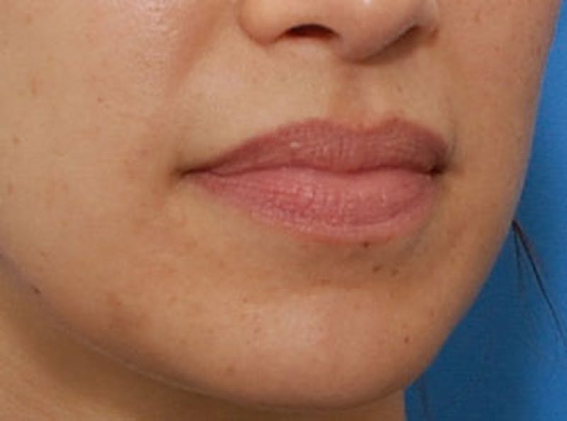 Lip Fillers Before & After Gallery - Patient 123678 - Image 6