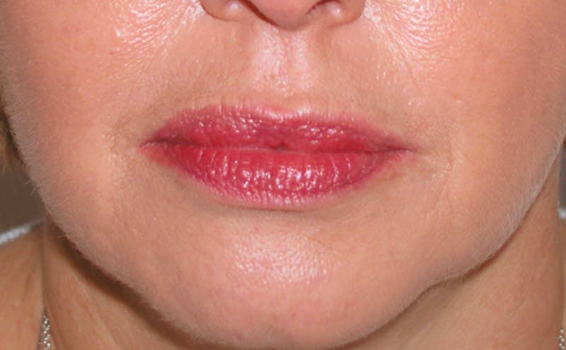 Fillers Before & After Gallery - Patient 370732 - Image 2
