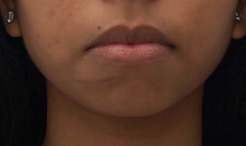 Chin Surgery Before & After Gallery - Patient 446897 - Image 3