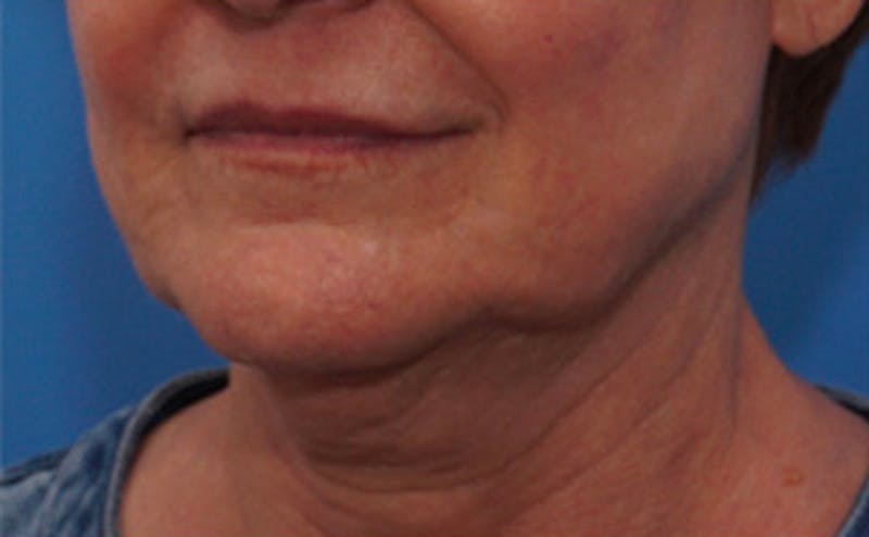 FaceTite Before & After Gallery - Patient 123057 - Image 5