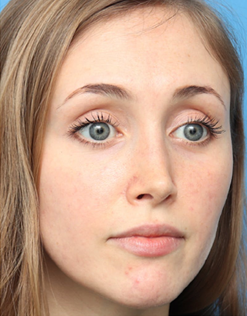 Rhinoplasty Before & After Gallery - Patient 315364 - Image 6