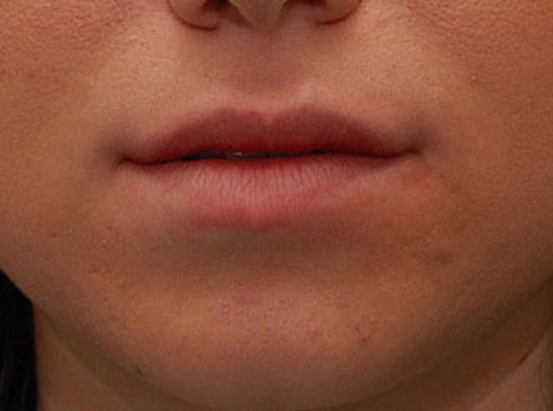 Lip Fillers Before & After Gallery - Patient 304187 - Image 1