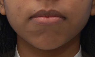 Chin Surgery Before & After Gallery - Patient 446897 - Image 4