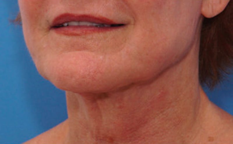 FaceTite Before & After Gallery - Patient 123057 - Image 6