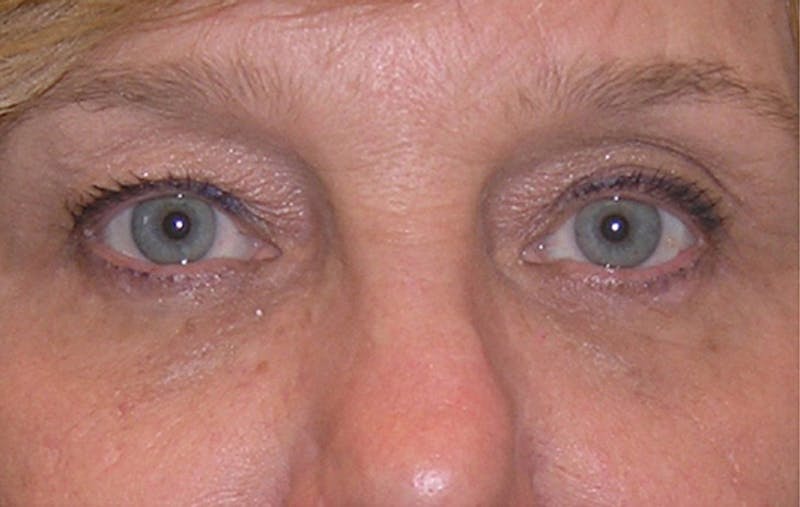 Patient KDw0ru-HRSGJ4sfNcGei0g - Eyelid Surgery Before & After Photos
