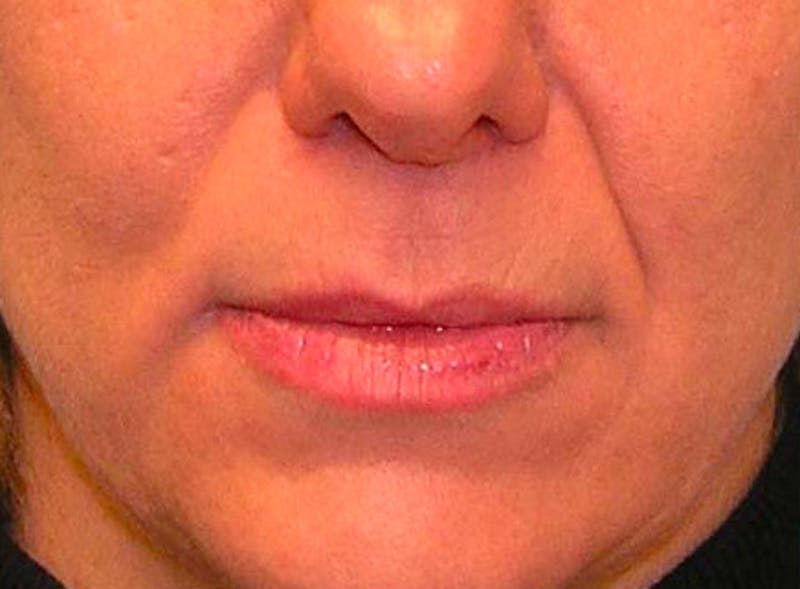 Patient X7ezeS4URk2IrhtlxPb4-Q - Fillers Before & After Photos