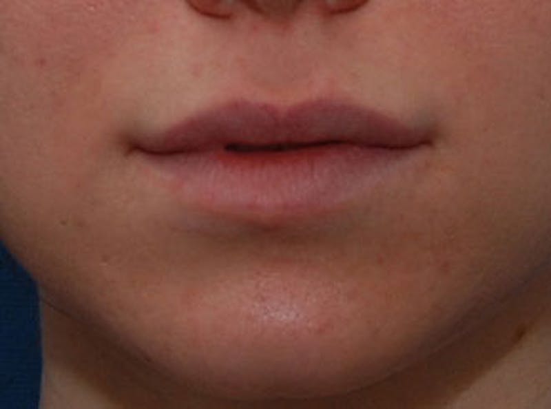 Lip Fillers Before & After Gallery - Patient 304187 - Image 2