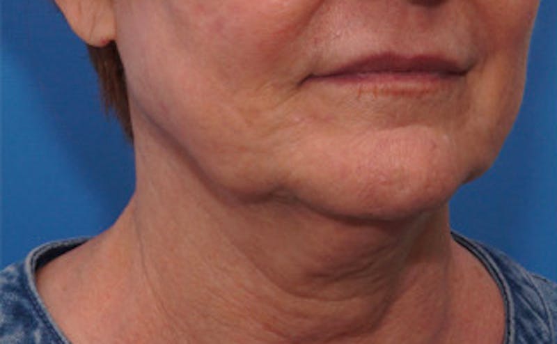 FaceTite Before & After Gallery - Patient 123057 - Image 7