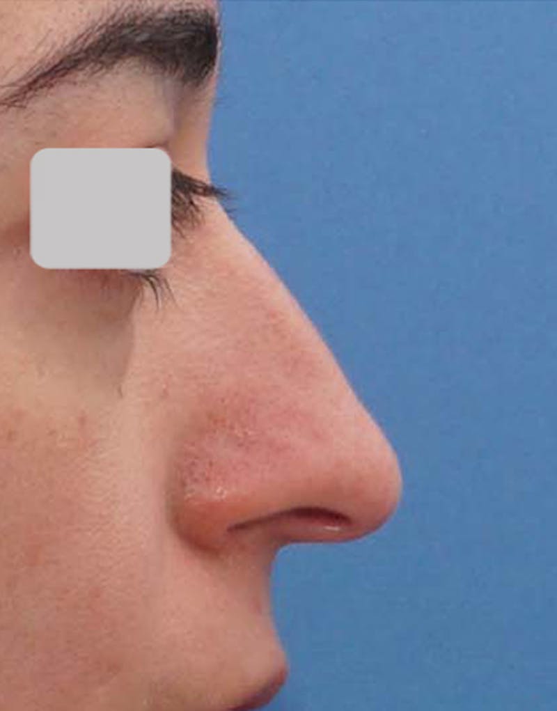Patient DbGU3GSETwaP0AW-4hFQ6g - Rhinoplasty Before & After Photos